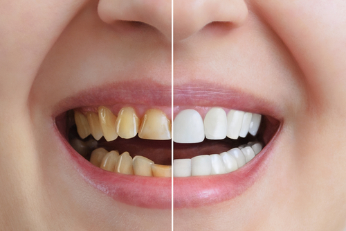 Transformation from stained to bright white teeth in Full Mouth Rehabilitation treatment in Indore.